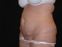 Tummy Tuck Before Photo by Jonathan Kramer, MD; Meridian, ID - Case 23467