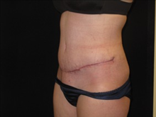 Tummy Tuck After Photo by Jonathan Kramer, MD; Meridian, ID - Case 23560