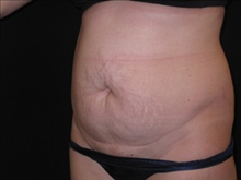 Tummy Tuck Before Photo by Jonathan Kramer, MD; Meridian, ID - Case 23560