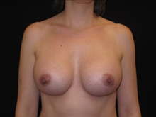 Breast Augmentation After Photo by Jonathan Kramer, MD; Meridian, ID - Case 23561