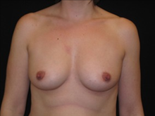 Breast Augmentation Before Photo by Jonathan Kramer, MD; Meridian, ID - Case 23561