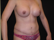 Tummy Tuck After Photo by Jonathan Kramer, MD; Meridian, ID - Case 23562