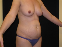 Tummy Tuck Before Photo by Jonathan Kramer, MD; Meridian, ID - Case 23562