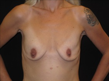 Breast Augmentation Before Photo by Jonathan Kramer, MD; Meridian, ID - Case 23589