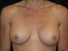 Breast Augmentation After Photo by Jonathan Kramer, MD; Meridian, ID - Case 23775