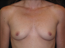 Breast Augmentation Before Photo by Jonathan Kramer, MD; Meridian, ID - Case 23775