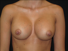 Breast Augmentation After Photo by Jonathan Kramer, MD; Meridian, ID - Case 23849