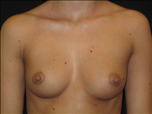 Breast Augmentation Before Photo by Jonathan Kramer, MD; Meridian, ID - Case 23849