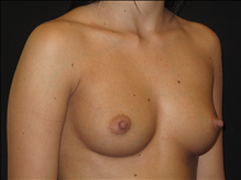 Breast Augmentation Before Photo by Jonathan Kramer, MD; Meridian, ID - Case 23849