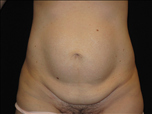 Tummy Tuck Before Photo by Jonathan Kramer, MD; Meridian, ID - Case 23964