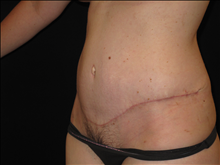 Tummy Tuck After Photo by Jonathan Kramer, MD; Meridian, ID - Case 23964