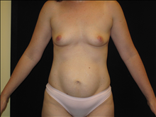 Tummy Tuck Before Photo by Jonathan Kramer, MD; Meridian, ID - Case 23964