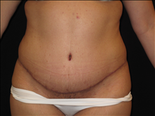 Tummy Tuck After Photo by Jonathan Kramer, MD; Meridian, ID - Case 23982