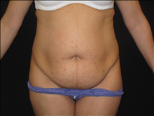 Tummy Tuck Before Photo by Jonathan Kramer, MD; Meridian, ID - Case 23982
