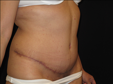 Tummy Tuck After Photo by Jonathan Kramer, MD; Meridian, ID - Case 23982