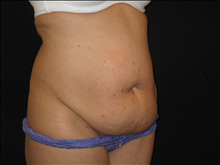 Tummy Tuck Before Photo by Jonathan Kramer, MD; Meridian, ID - Case 23982