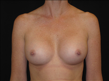 Breast Augmentation After Photo by Jonathan Kramer, MD; Meridian, ID - Case 23983