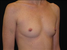 Breast Augmentation Before Photo by Jonathan Kramer, MD; Meridian, ID - Case 23983