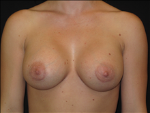 Breast Augmentation After Photo by Jonathan Kramer, MD; Meridian, ID - Case 24039