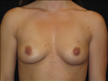 Breast Augmentation Before Photo by Jonathan Kramer, MD; Meridian, ID - Case 24039