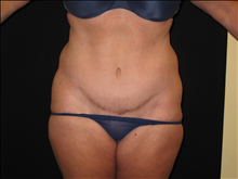 Tummy Tuck After Photo by Jonathan Kramer, MD; Meridian, ID - Case 24053