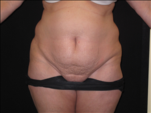 Tummy Tuck Before Photo by Jonathan Kramer, MD; Meridian, ID - Case 24053