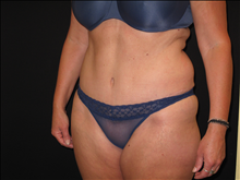 Tummy Tuck After Photo by Jonathan Kramer, MD; Meridian, ID - Case 24053
