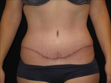 Tummy Tuck After Photo by Jonathan Kramer, MD; Meridian, ID - Case 24127