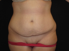 Tummy Tuck Before Photo by Jonathan Kramer, MD; Meridian, ID - Case 24127