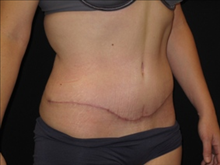 Tummy Tuck After Photo by Jonathan Kramer, MD; Meridian, ID - Case 24127