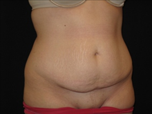 Tummy Tuck Before Photo by Jonathan Kramer, MD; Meridian, ID - Case 24127