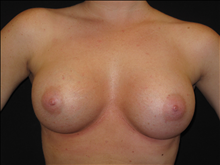 Breast Augmentation After Photo by Jonathan Kramer, MD; Meridian, ID - Case 24128