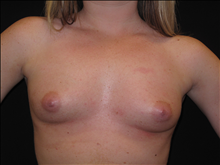 Breast Augmentation Before Photo by Jonathan Kramer, MD; Meridian, ID - Case 24128