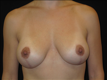 Breast Lift After Photo by Jonathan Kramer, MD; Meridian, ID - Case 24129
