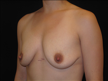 Breast Lift Before Photo by Jonathan Kramer, MD; Meridian, ID - Case 24129