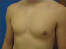 Male Breast Reduction After Photo by Jonathan Kramer, MD; Meridian, ID - Case 24130
