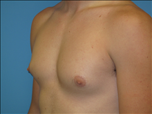 Male Breast Reduction Before Photo by Jonathan Kramer, MD; Meridian, ID - Case 24130