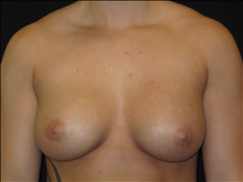 Breast Augmentation After Photo by Jonathan Kramer, MD; Meridian, ID - Case 24357