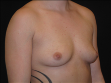Breast Augmentation Before Photo by Jonathan Kramer, MD; Meridian, ID - Case 24357