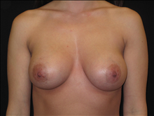 Breast Augmentation After Photo by Jonathan Kramer, MD; Meridian, ID - Case 24358