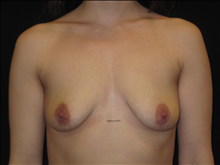 Breast Augmentation Before Photo by Jonathan Kramer, MD; Meridian, ID - Case 24358