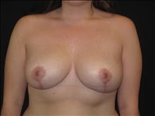 Breast Reduction After Photo by Jonathan Kramer, MD; Meridian, ID - Case 24359