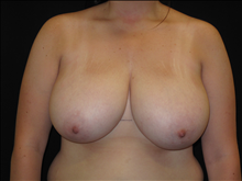 Breast Reduction Before Photo by Jonathan Kramer, MD; Meridian, ID - Case 24359
