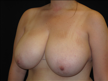 Breast Reduction Before Photo by Jonathan Kramer, MD; Meridian, ID - Case 24359