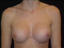 Breast Augmentation After Photo by Jonathan Kramer, MD; Meridian, ID - Case 24361