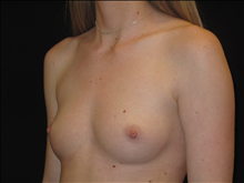 Breast Augmentation Before Photo by Jonathan Kramer, MD; Meridian, ID - Case 24361