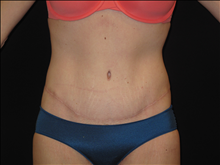 Tummy Tuck After Photo by Jonathan Kramer, MD; Meridian, ID - Case 24363