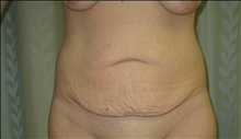 Tummy Tuck Before Photo by Jonathan Kramer, MD; Meridian, ID - Case 24363