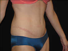 Tummy Tuck After Photo by Jonathan Kramer, MD; Meridian, ID - Case 24363