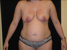 Tummy Tuck Before Photo by Jonathan Kramer, MD; Meridian, ID - Case 24364